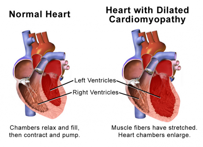 Dilated cardiomyopathy - Q10facts